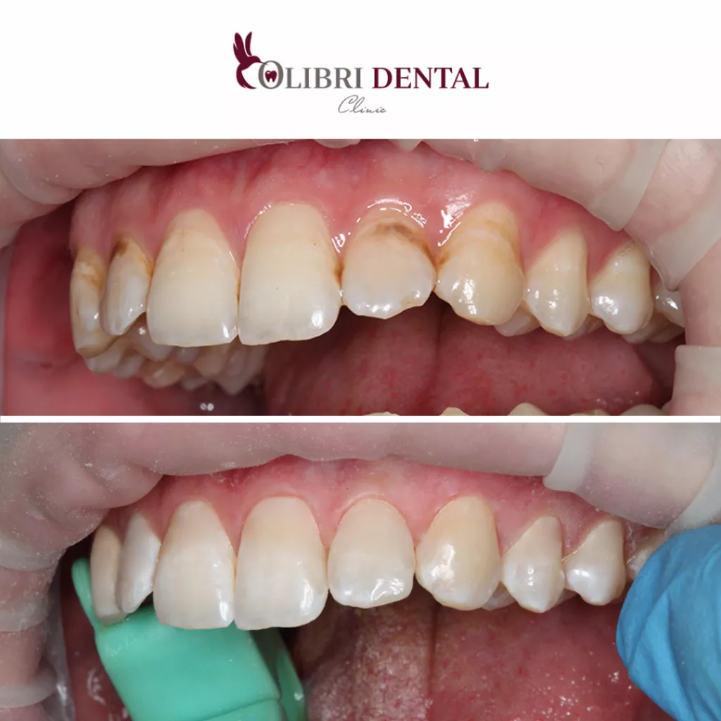 tokarev-case-colibri-dental-remineralizaciya.png