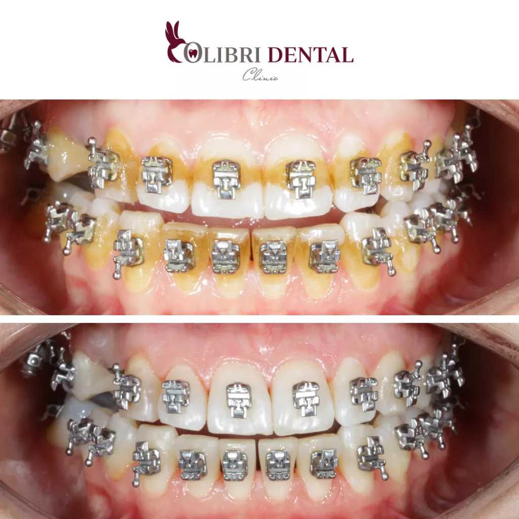 colibri-dental-gigiyenna-pri-ortodonticheskom-lechenii.png