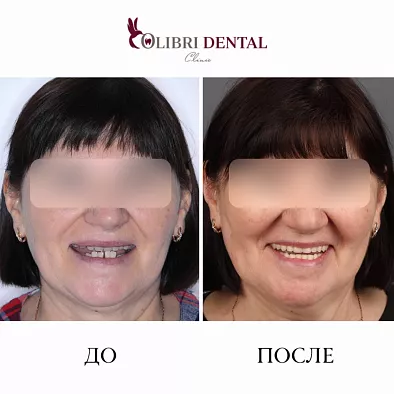 Лечение пациентки по методике All-on-4 